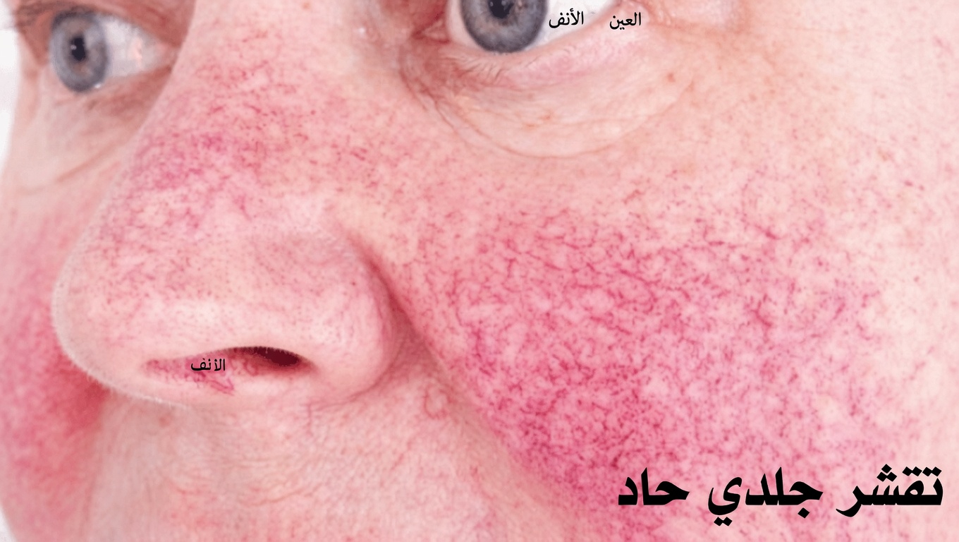 ما هي الآثار الجانبية الاثنا عشر الأكثر شيوعًا لأملوديبين والعادات اليومية التي يمكن أن تُحدث فرقًا؟