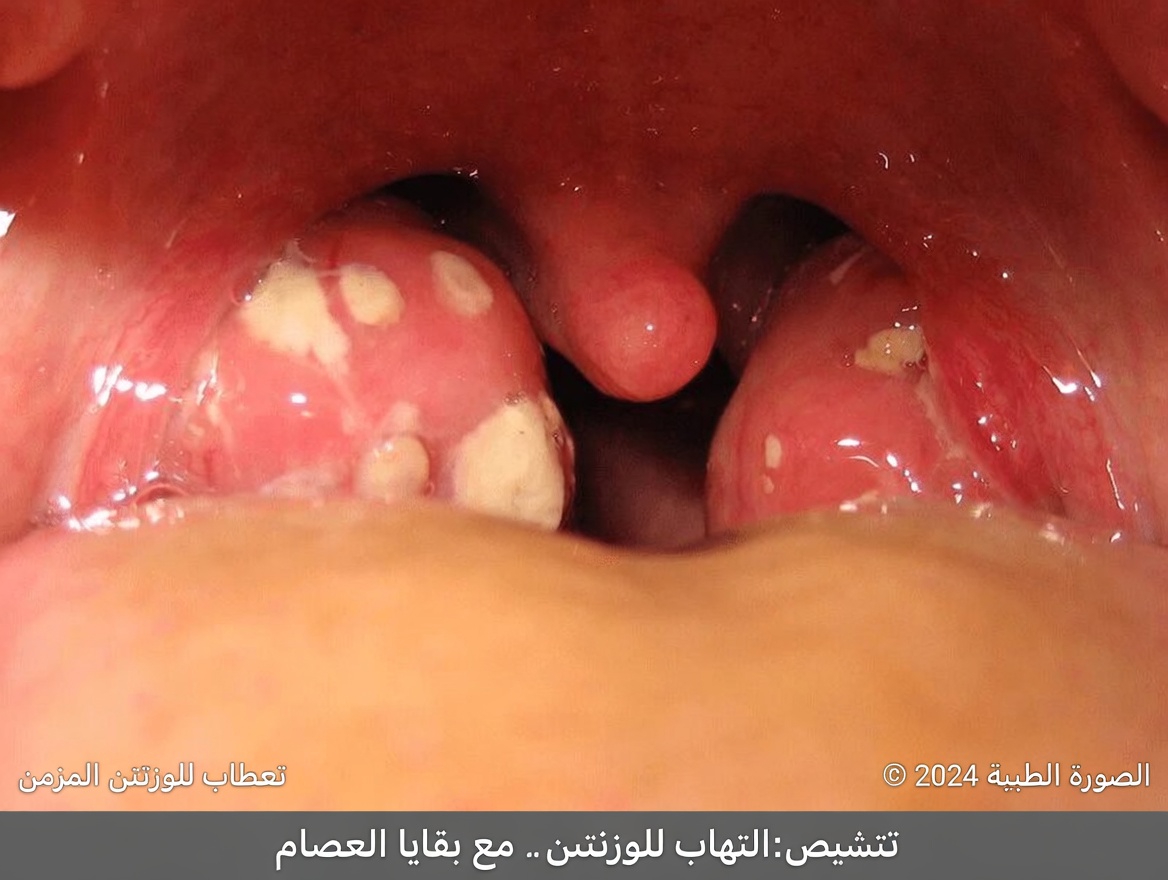 ما هي تلك النتوءات البيضاء في فمك وهل يمكن أن تكون مرتبطة بعادات يومية شائعة؟