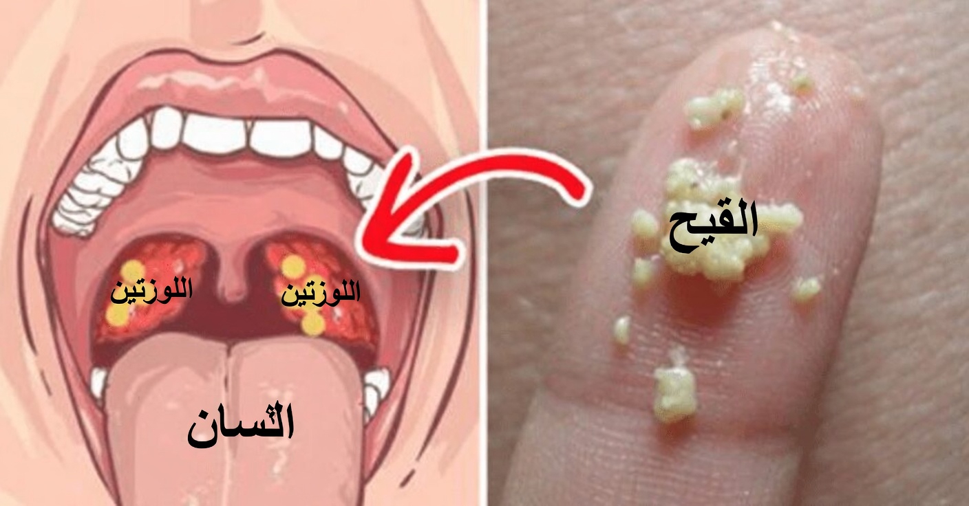 ما هي تلك النتوءات البيضاء في فمك وهل يمكن أن تكون مرتبطة بعادات يومية شائعة؟