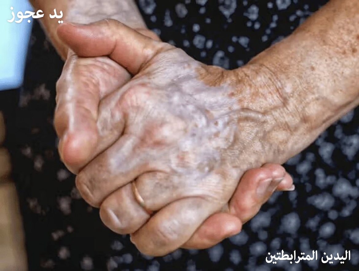 لماذا أصبحت أوردة يديك بارزة جدًا؟ استكشاف الأسباب الشائعة ومعلومات مفيدة