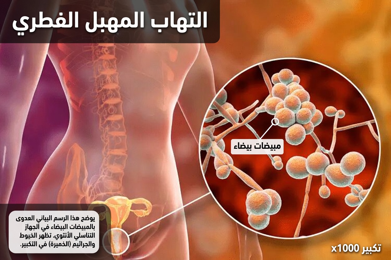 ما العلامات الشائعة لعدوى الخميرة المهبلية التي ينبغي لكل امرأة أن تعرفها؟