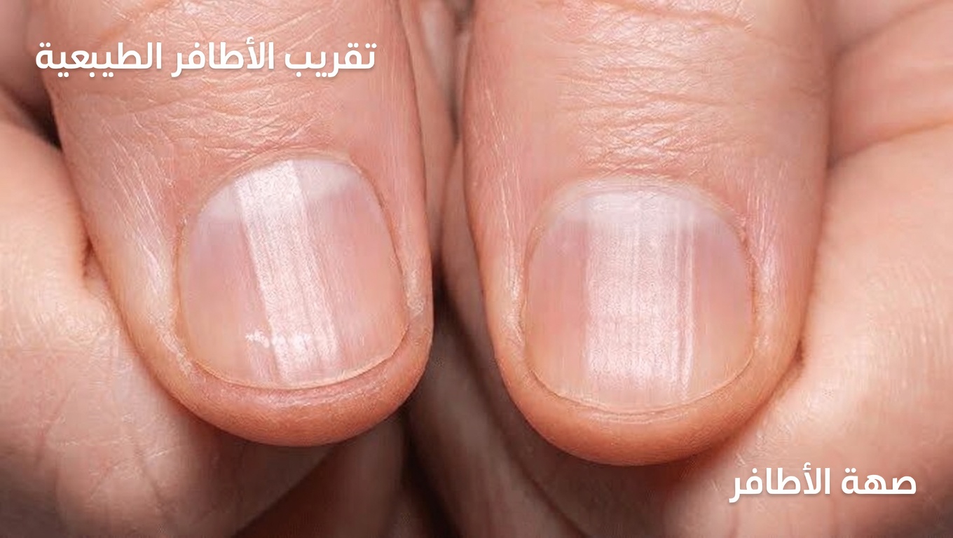 ماذا تعني تلك النتوءات على أظافرك حقًا؟ عادات يومية بسيطة لدعم أظافر أكثر صحة