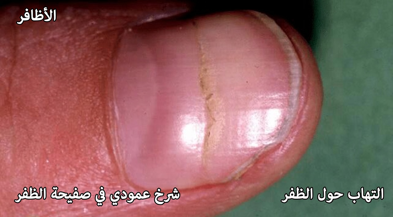 ماذا تعني تلك النتوءات على أظافرك حقًا؟ عادات يومية بسيطة لدعم أظافر أكثر صحة