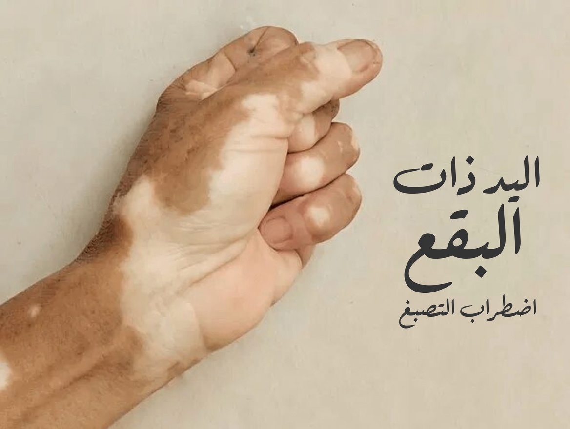 لماذا تظهر بقع بيضاء على ذراعيك وساقيك؟ فهم الأسباب الشائعة ونصائح للعناية بالبشرة
