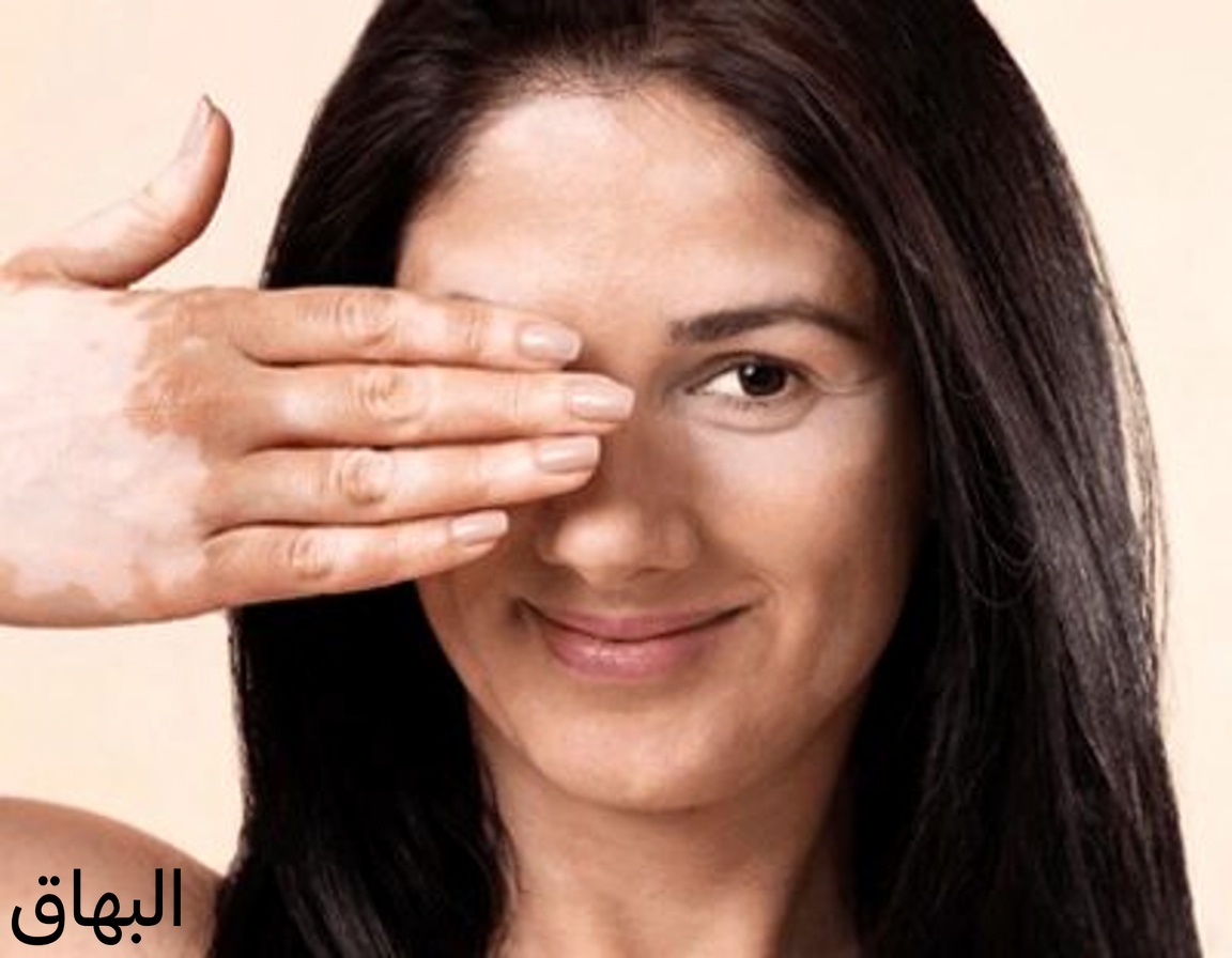 لماذا تظهر بقع بيضاء على ذراعيك وساقيك؟ فهم الأسباب الشائعة ونصائح للعناية بالبشرة