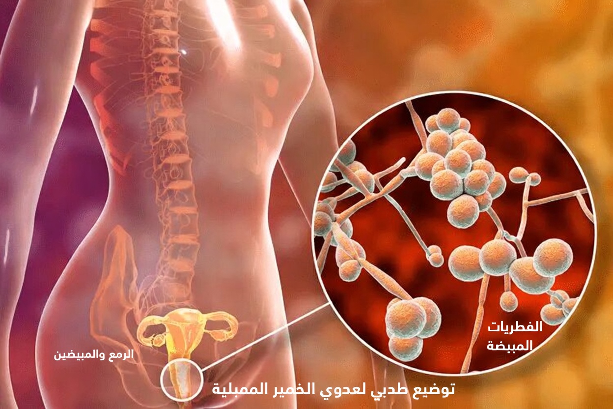 ما هي العلامات الشائعة لعدوى الخميرة المهبلية التي يجب على كل امرأة معرفتها؟
