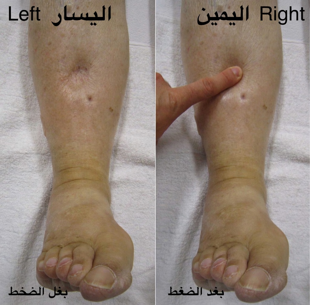 ما هي الآثار الجانبية الاثنا عشر الأكثر شيوعًا لأملوديبين والعادات اليومية التي يمكن أن تُحدث فرقًا؟