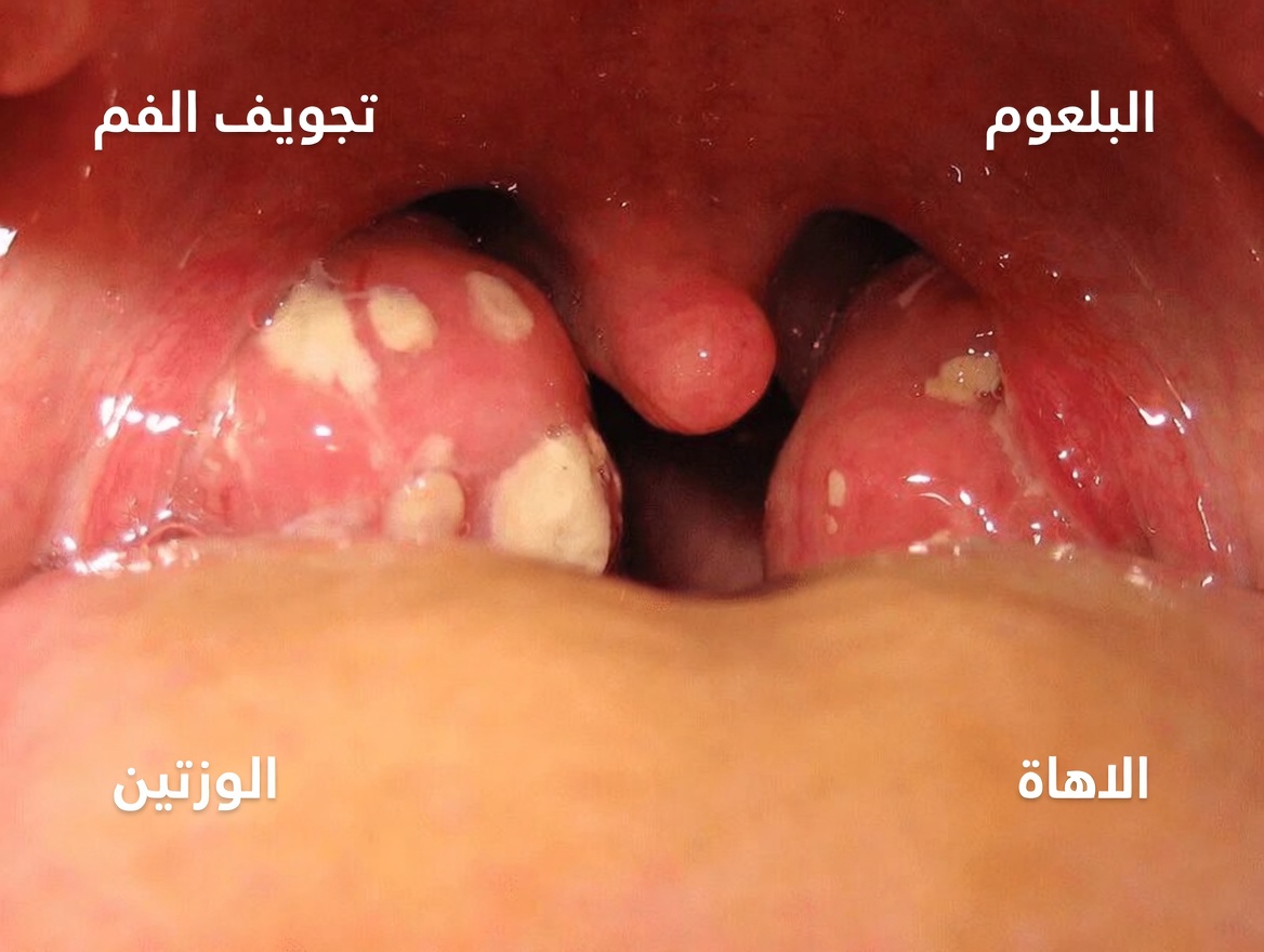 ما تلك النتوءات البيضاء في فمك وهل يمكن أن تكون مرتبطة بعادات يومية شائعة؟
