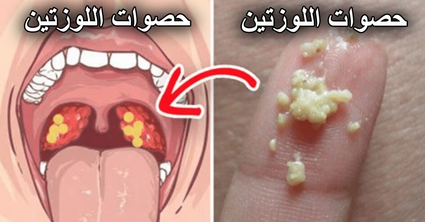 ما تلك النتوءات البيضاء في فمك وهل يمكن أن تكون مرتبطة بعادات يومية شائعة؟