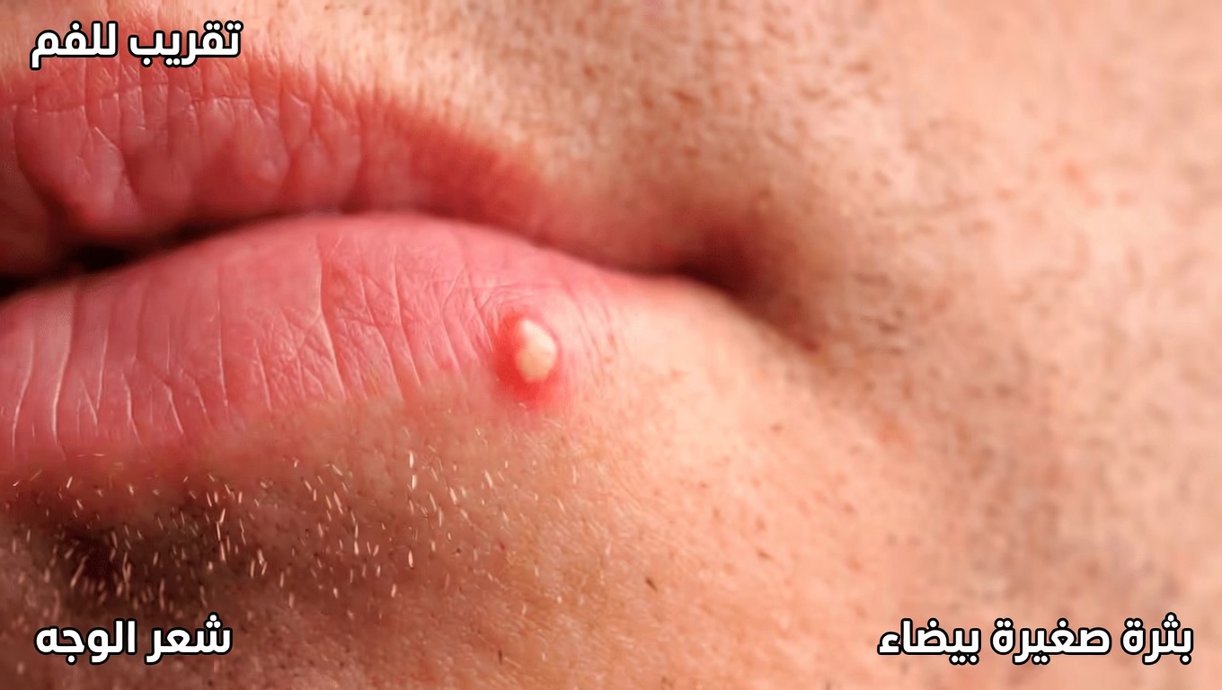 تلك النتوءات البيضاء المزعجة على شفتيك أو في الأسفل؟ إليك الحقيقة كاملة