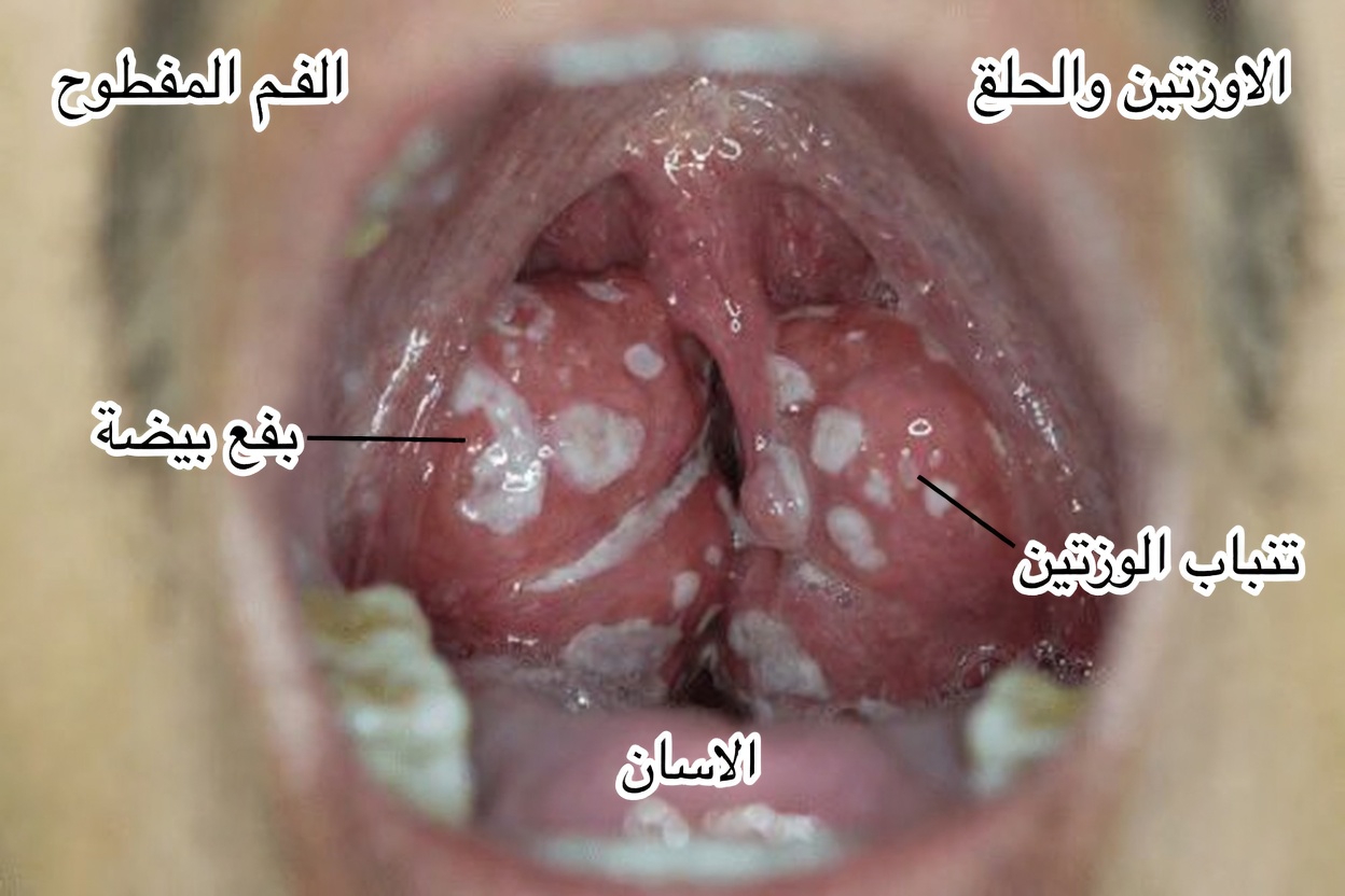 إليك الحقيقة المقززة عن حصوات اللوزتين والعادات اليومية البسيطة التي يجب معرفتها