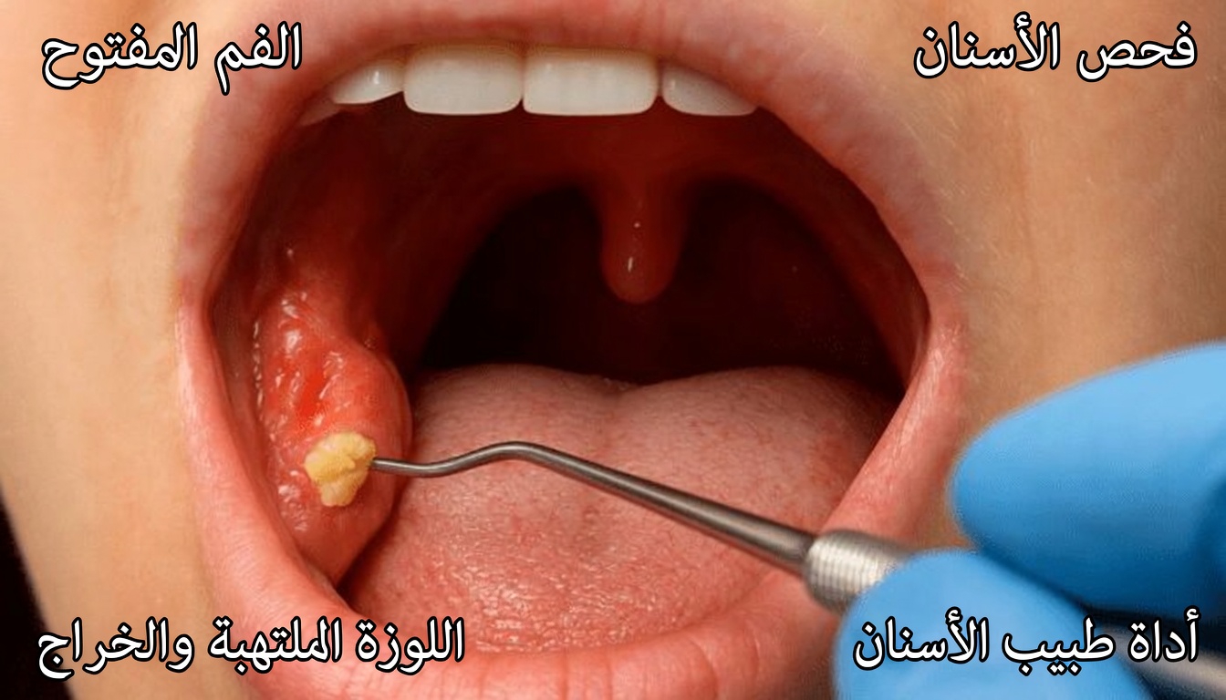 إليك الحقيقة المقززة عن حصوات اللوزتين والعادات اليومية البسيطة التي يجب معرفتها