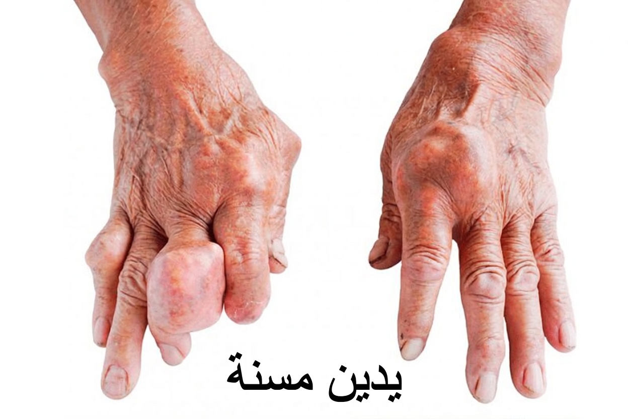 اكتشف كيف يمكن للعادات اليومية والمقويات الطبيعية أن تساعد في دعم مستويات صحية لحمض اليوريك من أجل راحة أفضل للمفاصل