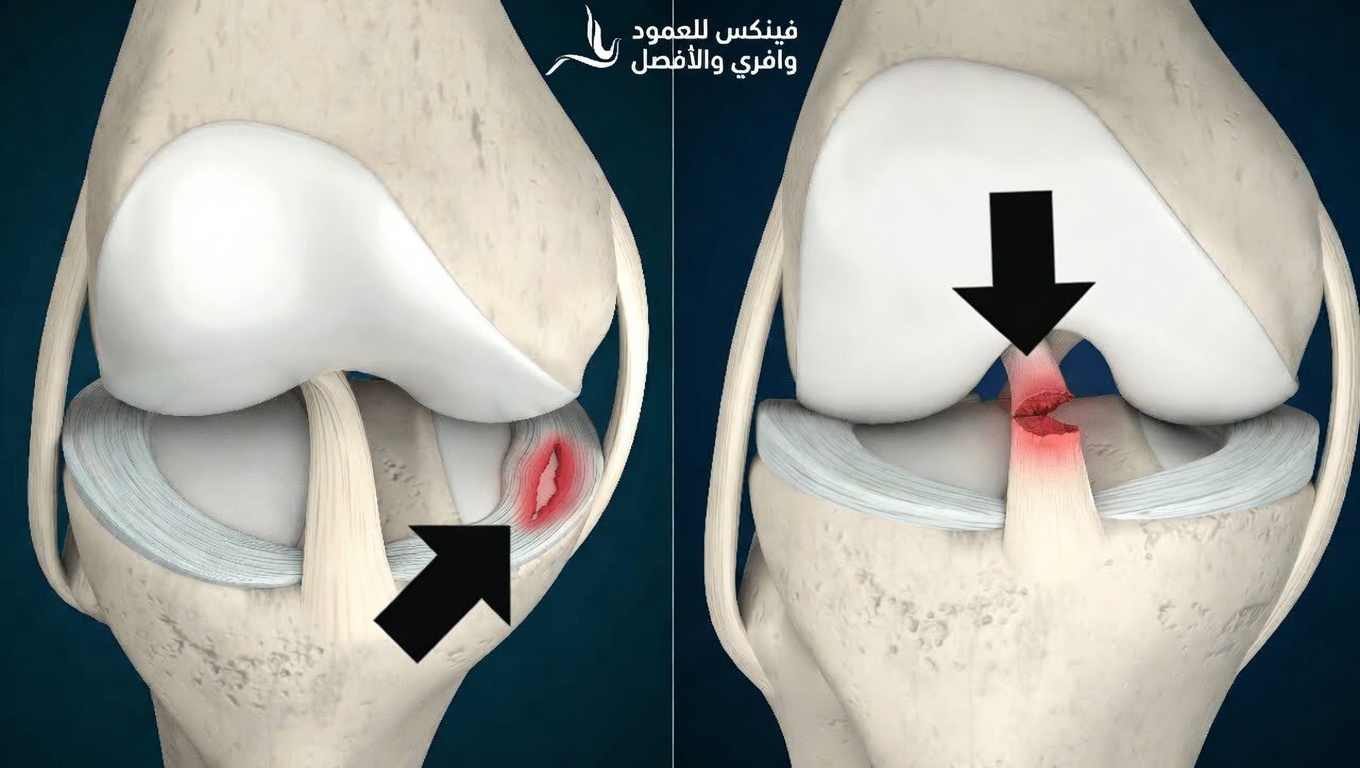 ماذا يحدث لركبتك عند تمزق الرباط المتصالب؟ العلامات، الأسباب، وما الذي يحدث بعد ذلك