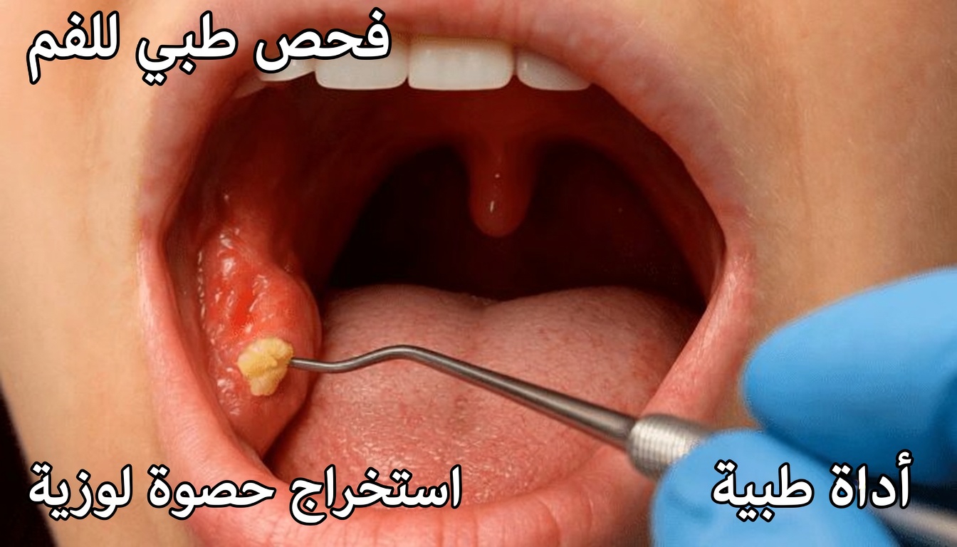 ما هي حصوات اللوزتين وكيف يمكن للعادات اليومية البسيطة أن تساعدك في التعامل مع هذه المشكلات الخفية في الحلق؟