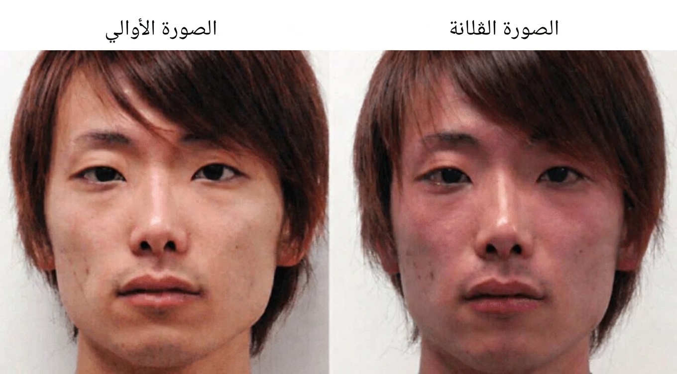 12 من الآثار الجانبية لأملوديبين التي يجب أن تكون على دراية بها – دليل كامل للمستخدمين