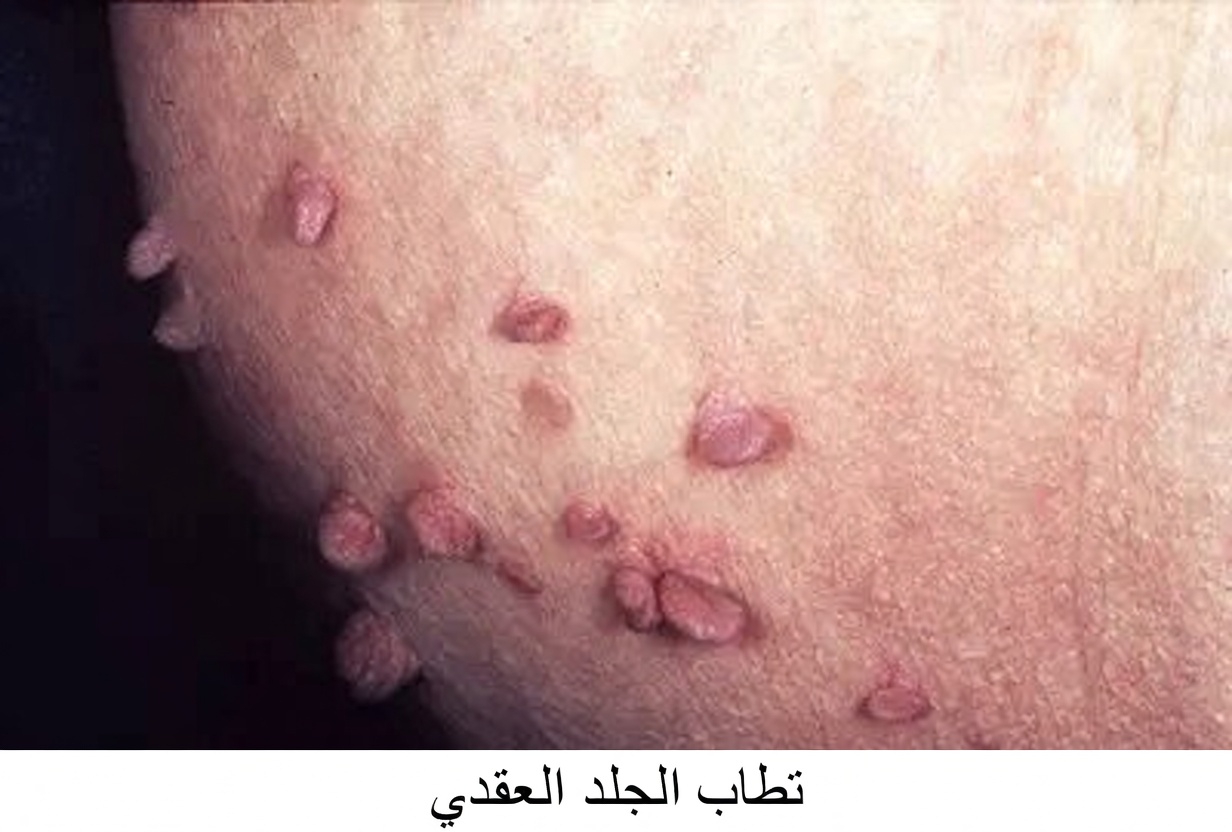 11 علامة على مرض السكري لا يعرفها سوى القليل من الناس وقد تكون مختبئة على مرأى من الجميع