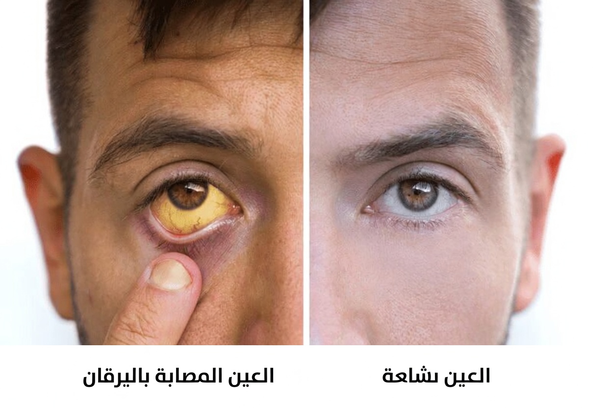 12 علامة صامتة لفشل الكبد يجب أن تكتشفها مبكرًا (قبل فوات الأوان!)