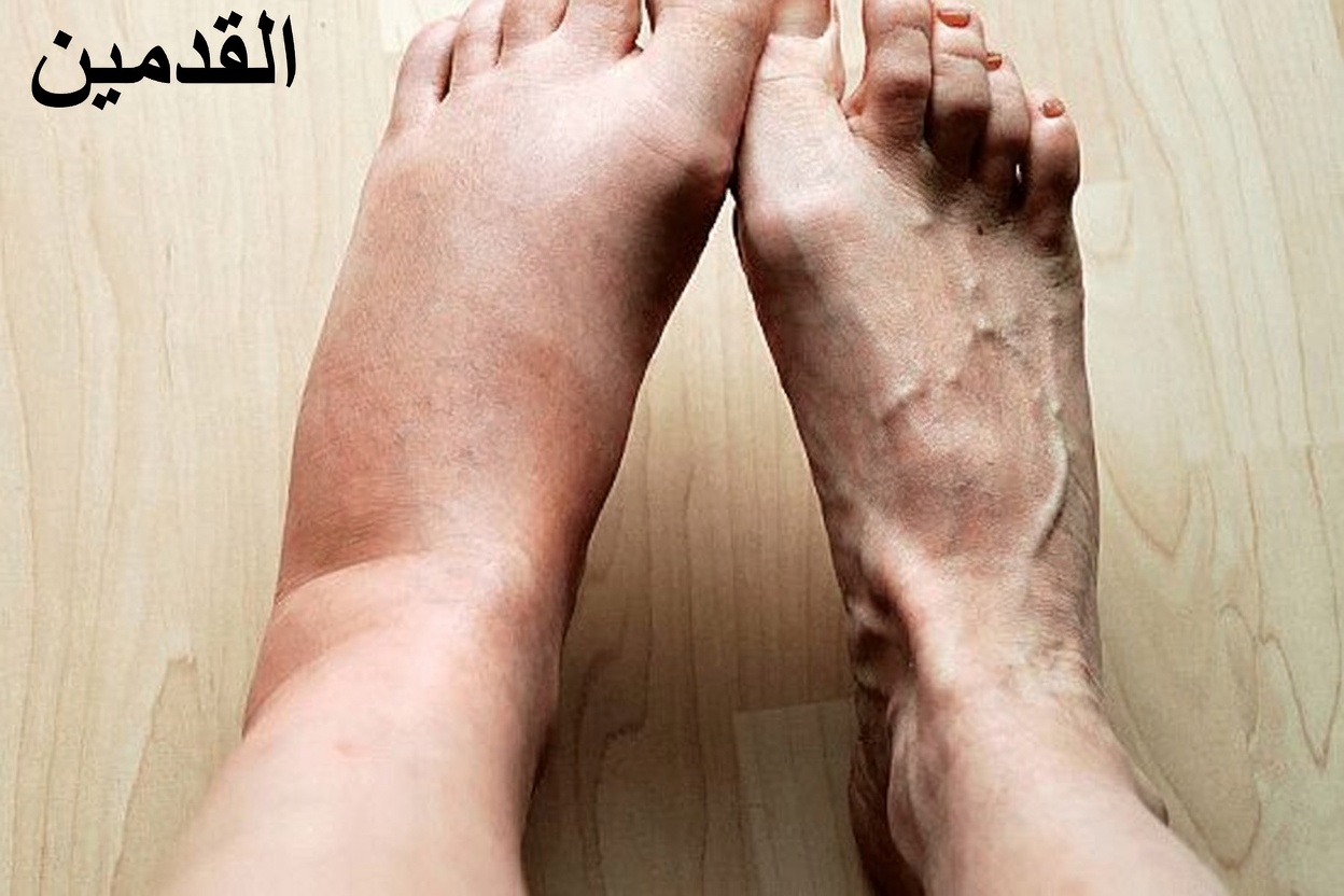 ما الذي قد يكشفه تورّم الساقين عن صحتك – ولماذا يهم ذلك