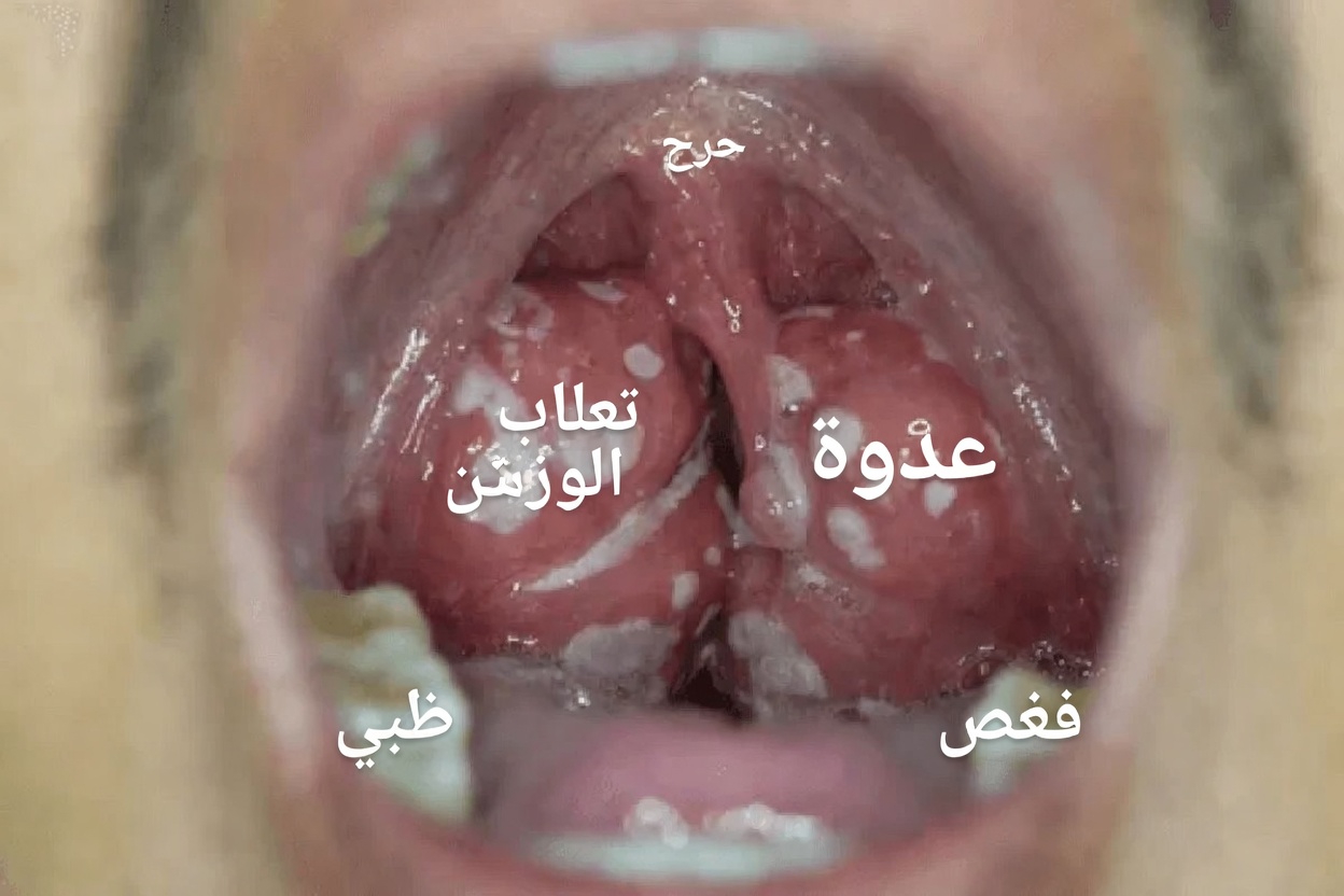 حصى اللوزتين: ما هي، ولماذا تحدث، وعادات يومية بسيطة للتعامل معها