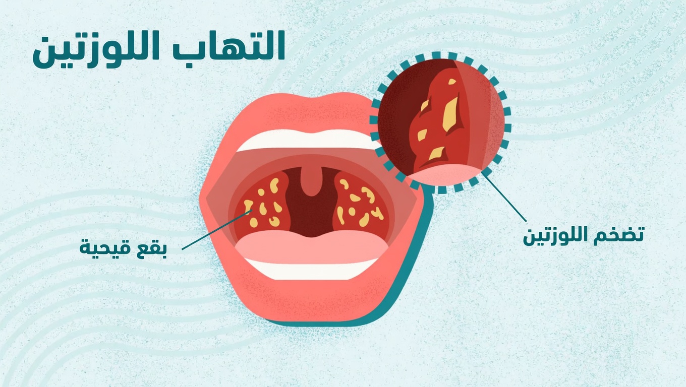 حصى اللوزتين: ما هي، ولماذا تحدث، وعادات يومية بسيطة للتعامل معها