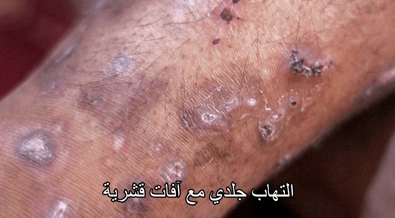 12 علامة لتليّف الكبد يجب أن تعرفها لدعم الوعي بصحة الكبد