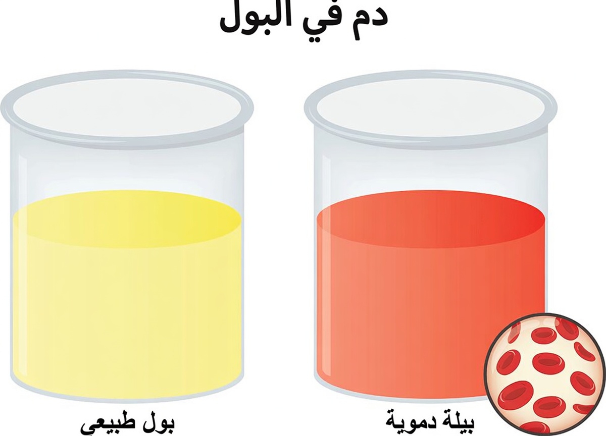 6 علامات لمرض الكلى قد تظهر في حياتك اليومية ولماذا هي مهمة