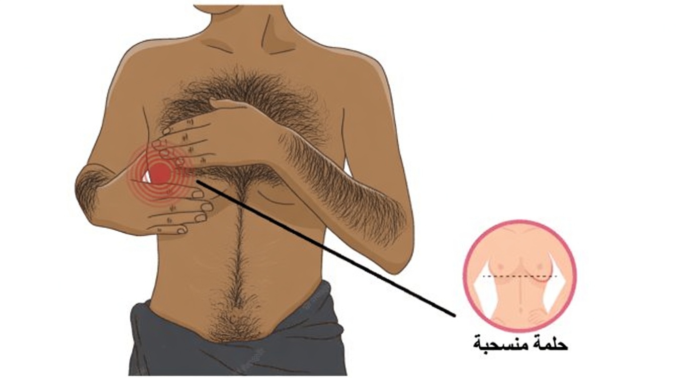 ما هي التغيرات العشرة المهمة في الثدي التي تتجاهلها كثير من النساء ويجب عليهن مناقشتها مع الطبيب؟