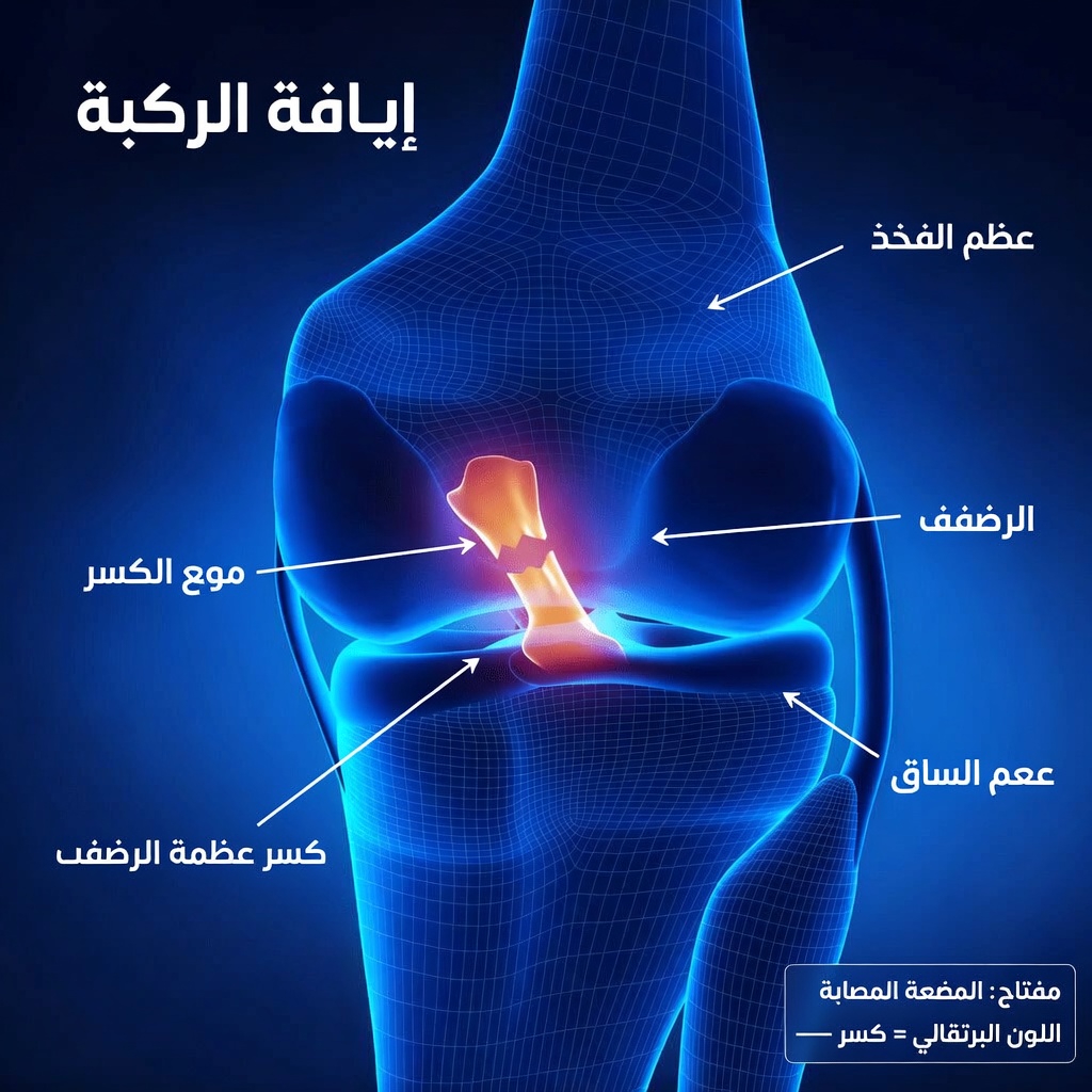 شرح تمزق الرباط الصليبي الأمامي: ماذا يحدث للركبة عند تمزق الرباط الصليبي الأمامي – أبرز المعلومات