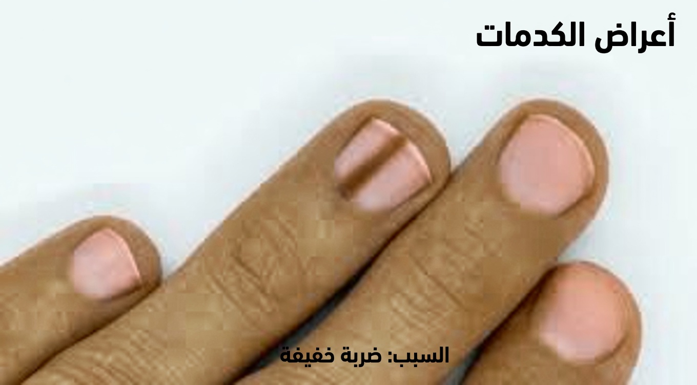 14 علامة مرئية للسرطان تتجاهلها معظم النساء ولكن يجب أن يعرفنها