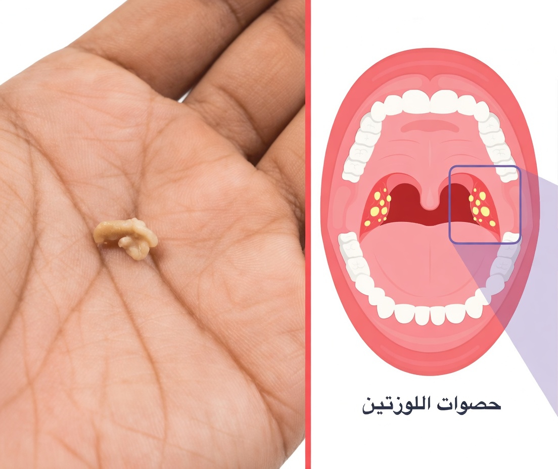 فهم حصوات اللوزتين: هل يمكن أن تكون السبب الخفي وراء رائحة فمك الكريهة المستمرة؟