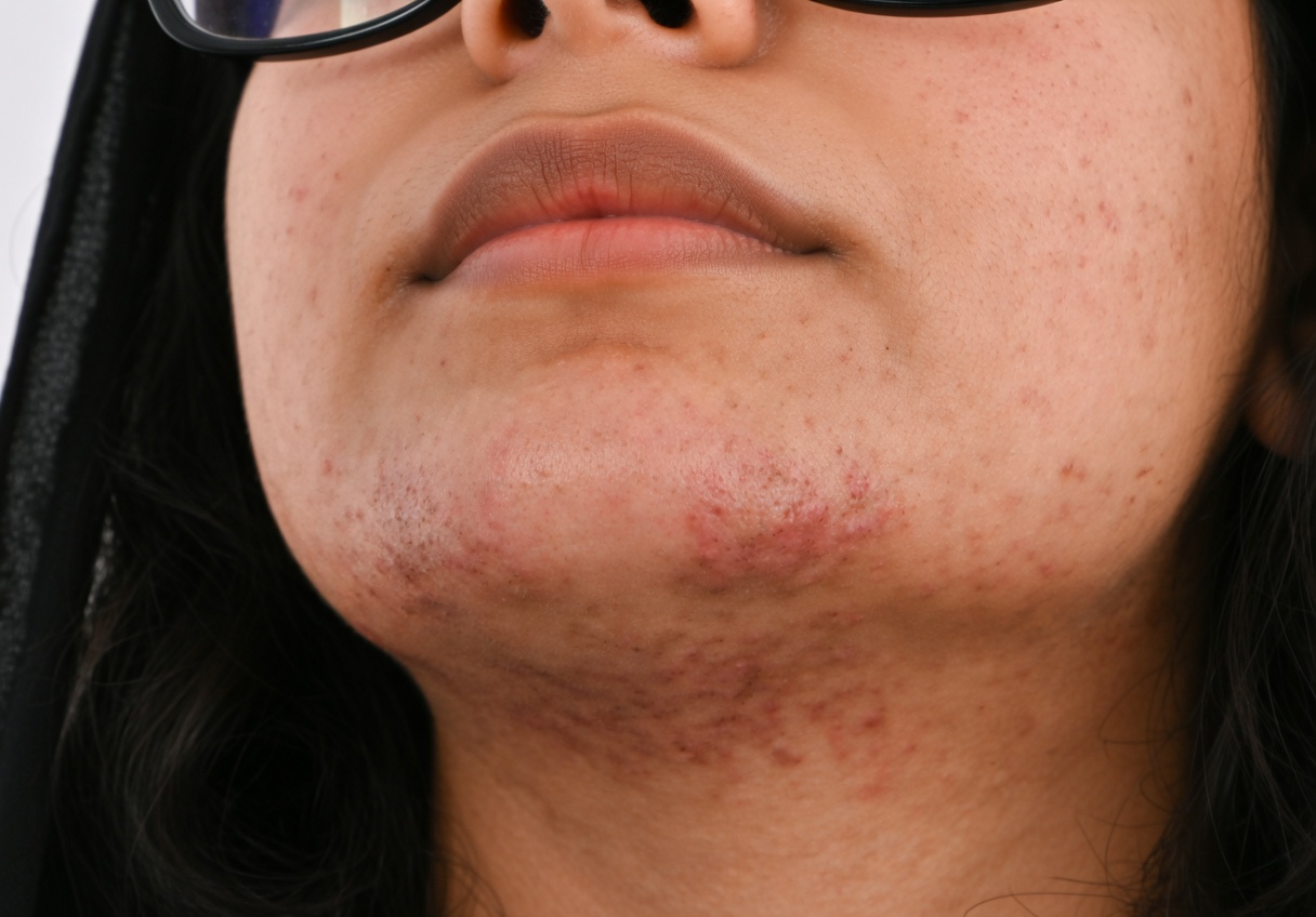 شعر الذقن لدى النساء: ما أسبابه ومتى ينبغي الانتباه إلى هرموناتك