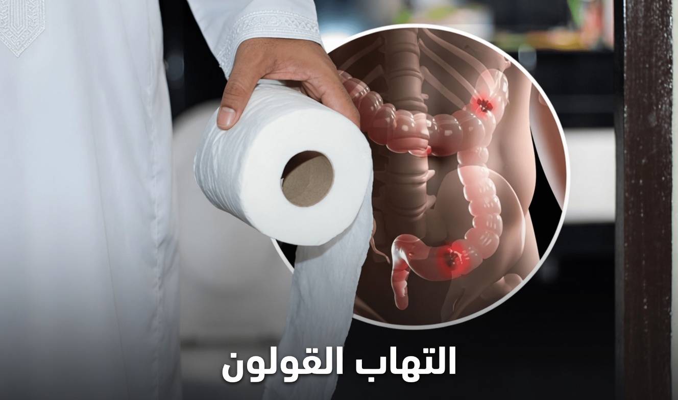 7 أعراض خطيرة لسرطان القولون يجب ألا تتجاهلها أبدًا وما قد تعنيه لصحتك