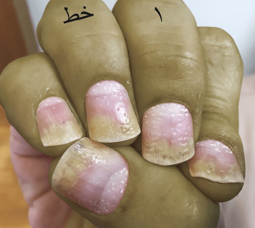 اكتشف لماذا يحظى القرنفل باهتمام متزايد لدعم صحة الأظافر: وصفات بسيطة وفوائد وعادات يومية مشروحة