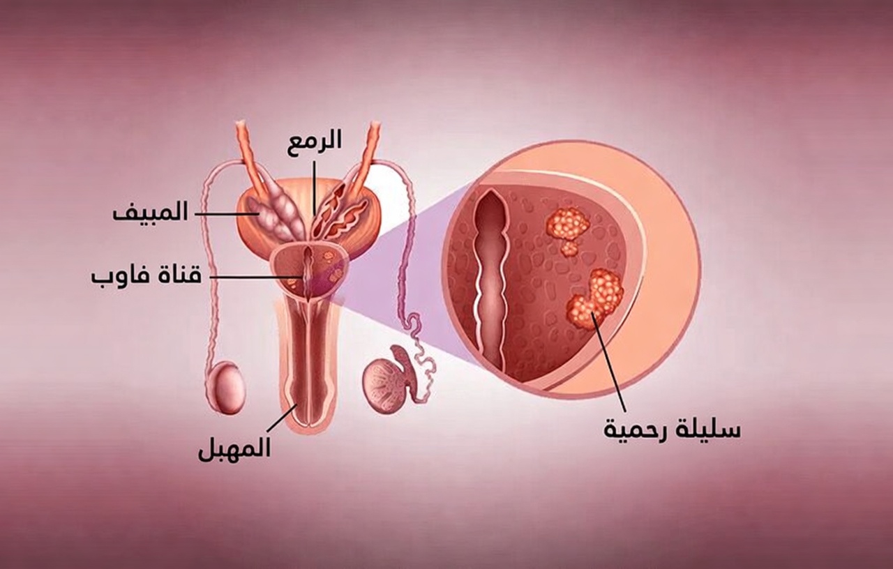 ماذا تكشف أحدث الأبحاث عن القشطة الشائكة (غرافيولا) لصحة البروستاتا؟ رؤى واعتبارات مهمة