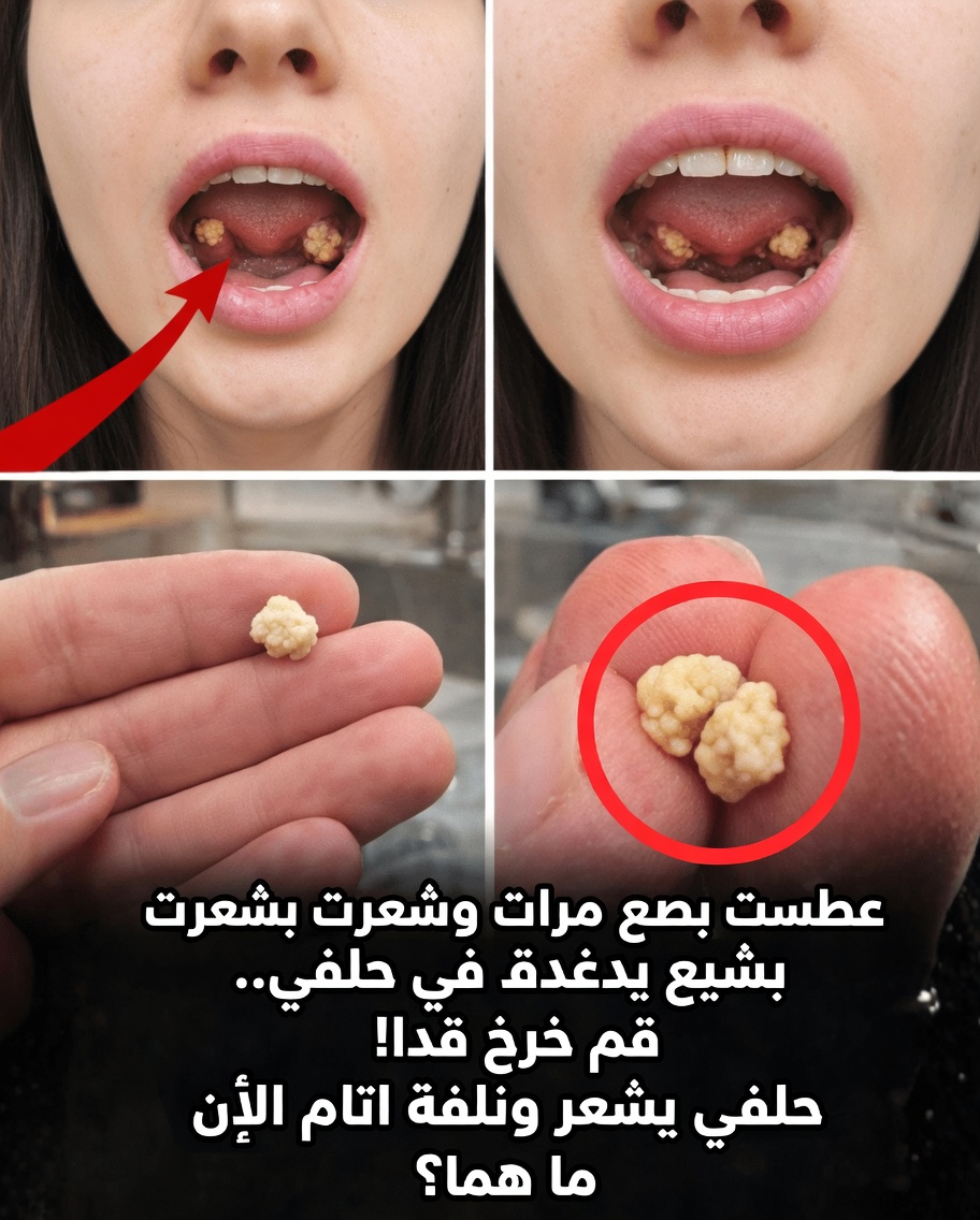 ما تلك الكتلة الغريبة التي سعلتها بعد العطس؟ استكشاف حصوات اللوزتين وما تعنيه