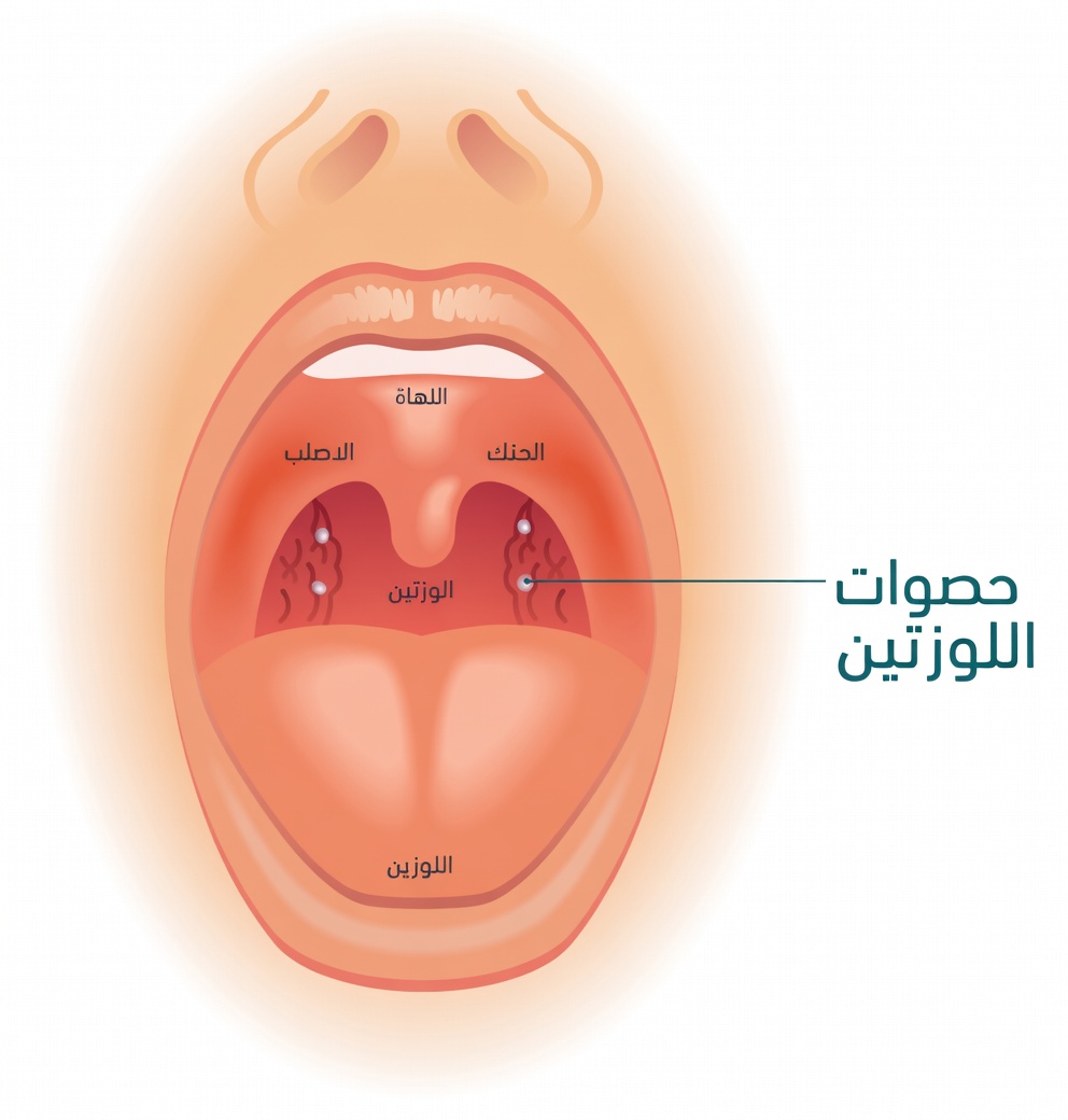 ما تلك الكتلة الغريبة التي سعلتها بعد العطس؟ استكشاف حصوات اللوزتين وما تعنيه