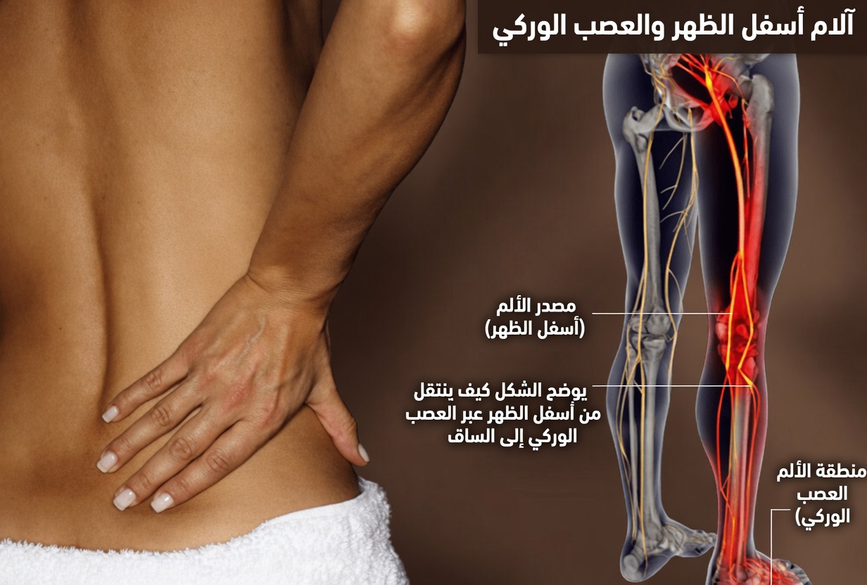 دليل شامل لعرق النسا: فهم الأسباب، وتحديد الأعراض، واستكشاف العادات التي تساعد على إدارة انزعاج العصب