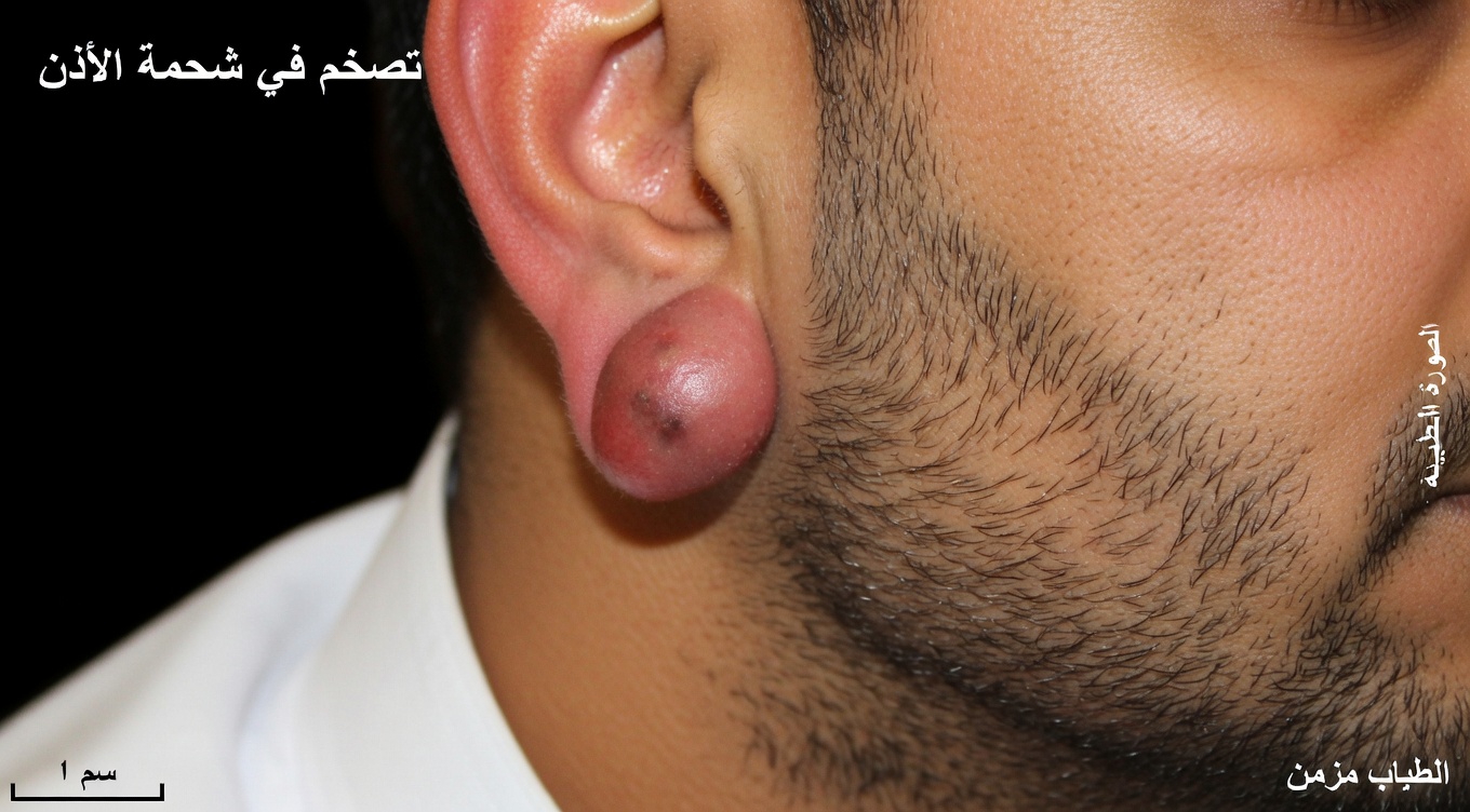 ما تحتاج إلى معرفته عن الأكياس الدهنية: الأسباب الرئيسية وخيارات العلاجات المنزلية التي يمكنك استكشافها