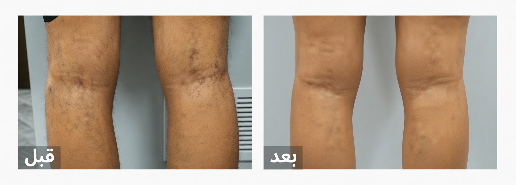 علاج الجدة السري لدوالي الأوردة: لماذا يستكشف الكثيرون فوق سن الخمسين الألوفيرا وخل التفاح والليمون لراحة الساقين