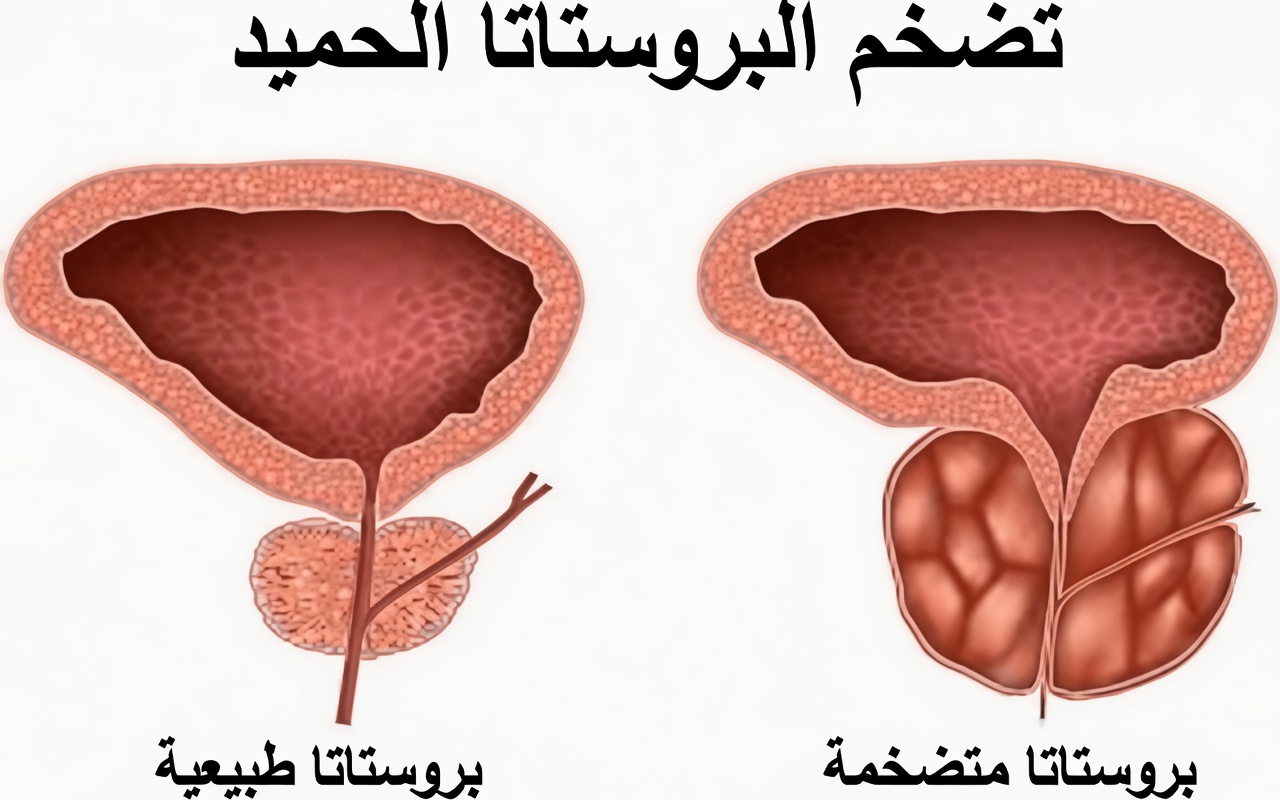 المشروب العشبي الذي قد يدعم صحة البروستاتا بشكل طبيعي (نهج لطيف يومي للعافية)