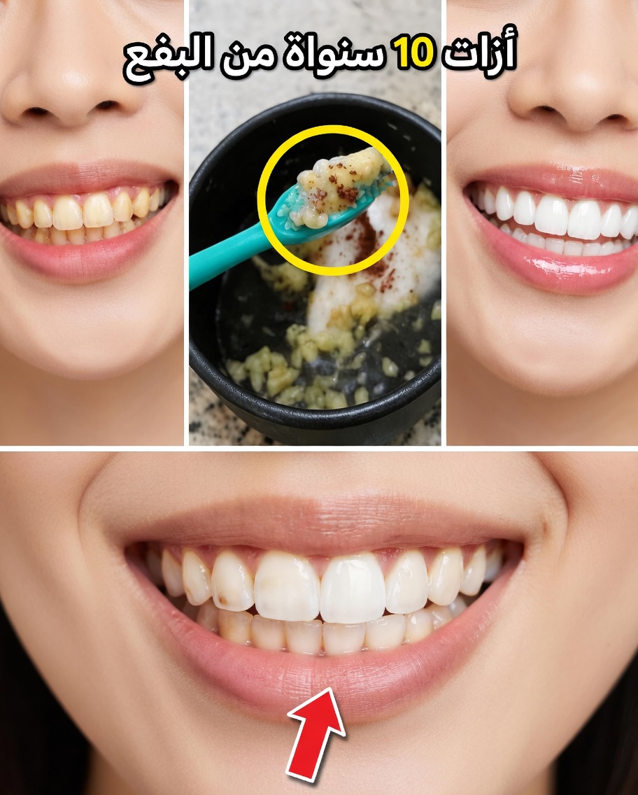 جرّب هذه الحيلة السهلة لتبييض الأسنان بالثوم في دقيقتين باستخدام مكونات من المطبخ لابتسامة أكثر إشراقًا