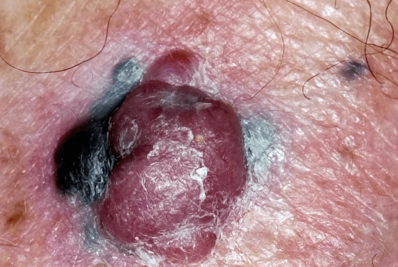 14 علامة تحذيرية للسرطان يجب ألا تتجاهلها أبدًا – قد ينقذ الكشف المبكر حياتك