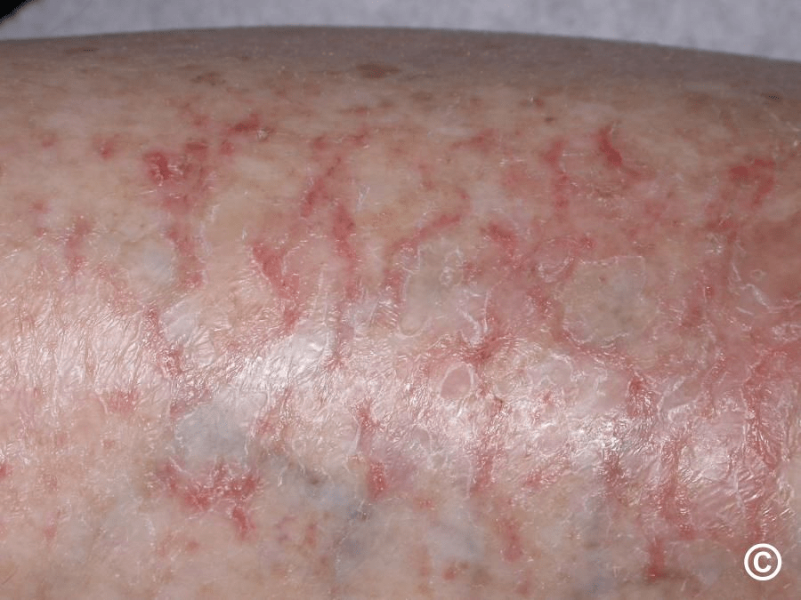 اكتشف ما تكشفه قدماك عن صحة كبدك: 12 علامة شائعة يجب الانتباه إليها