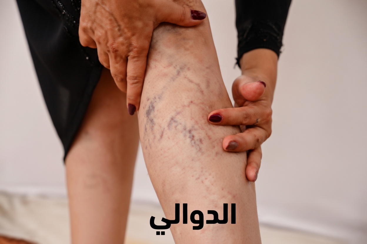 10 طرق طبيعية لدعم صحة الأوردة وتحسين تدفق الدم لعلاج الدوالي