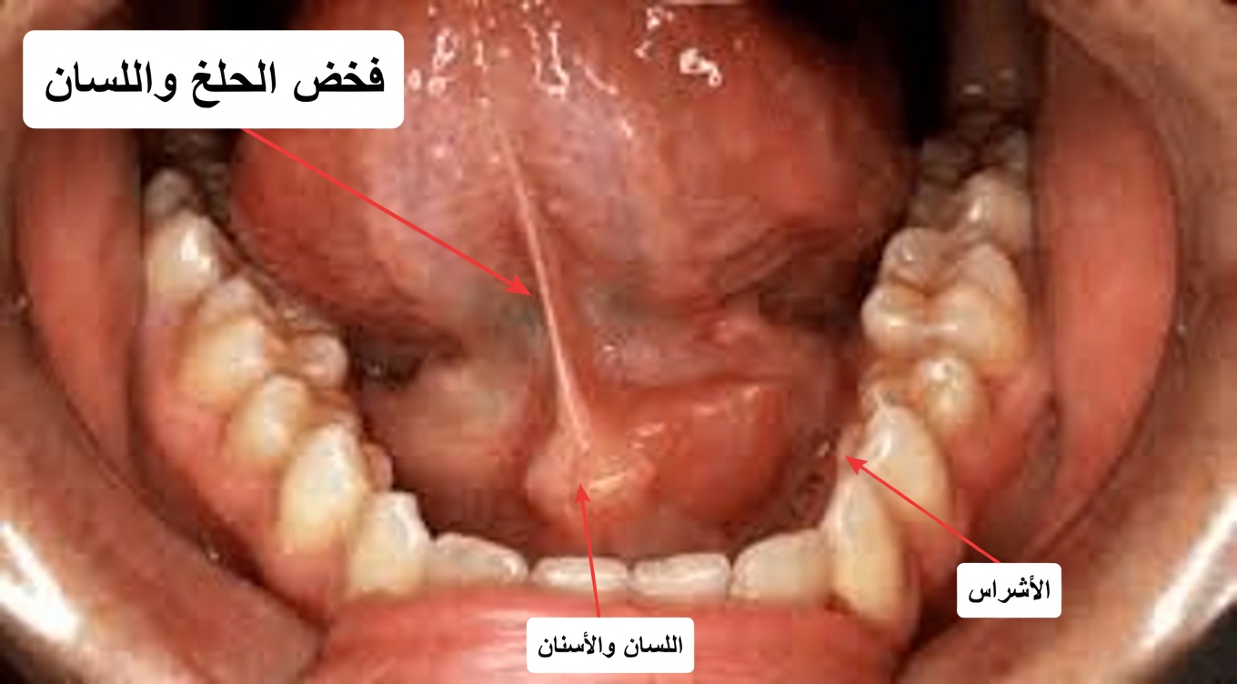 لماذا تستيقظ باستمرار وفمك جاف—وما الذي قد يخبرك به ذلك