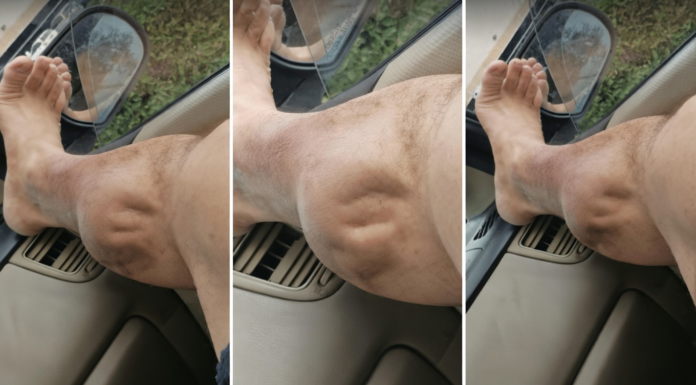 ١٢ عرضًا مهمًا لفشل القلب الاحتقاني قد تظهر في ساقيك وقدميك