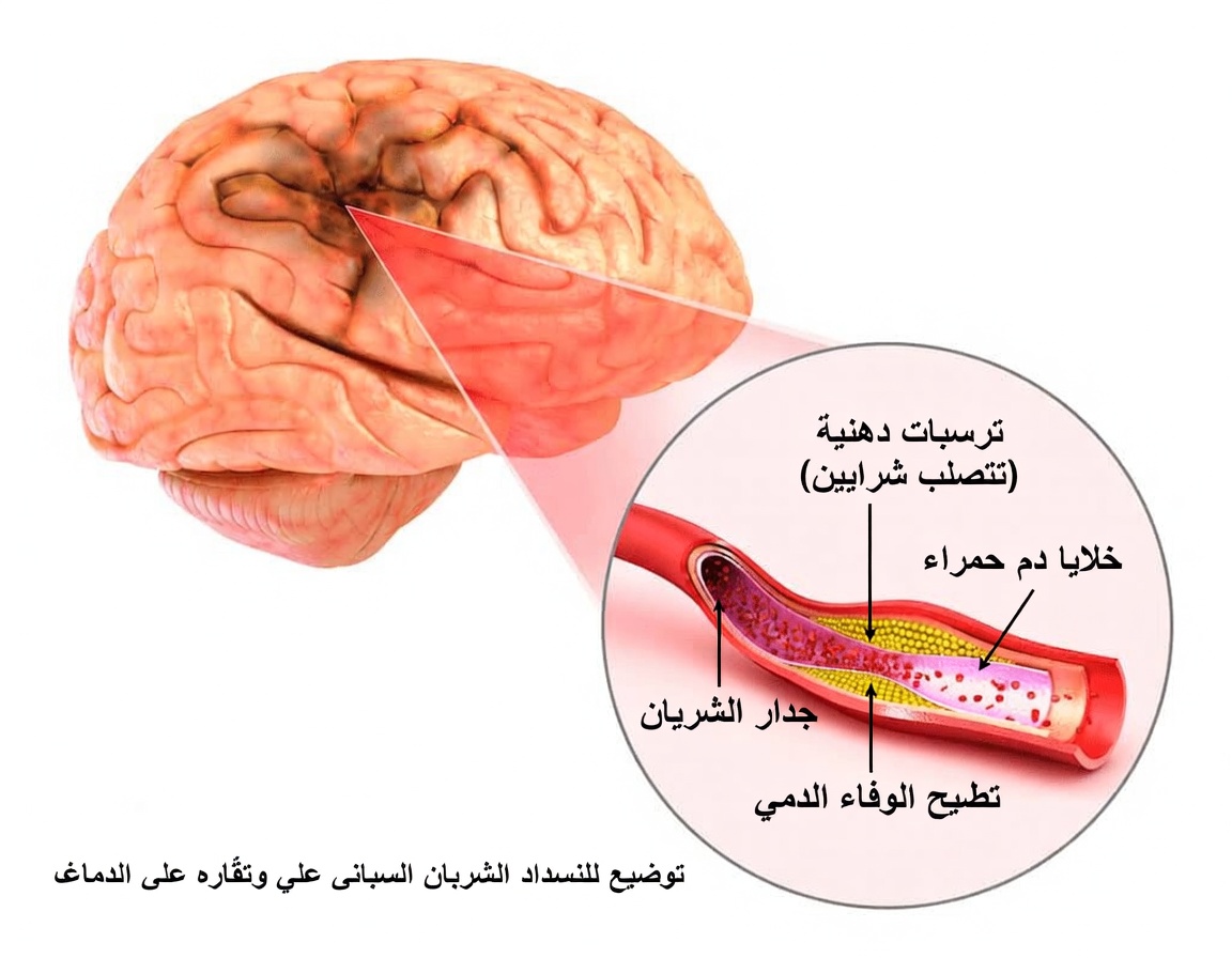 10 أعراض لسكتات دماغية صامتة بعد سنّ الستين تُفَوَّت غالبًا (خصوصًا العرض رقم 4 – علامة تحذير لـ«لحظة النسيان» لدى الكبار)