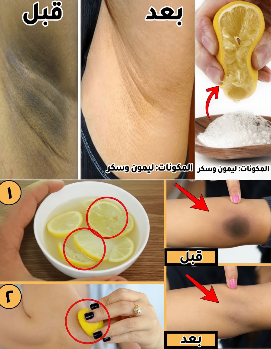 الليمون على المرفقين والركبتين وتحت الإبطين: الحيلة اللطيفة خلال 5 دقائق التي محَت 10 أعوام من البقع الداكنة لآلاف الأشخاص