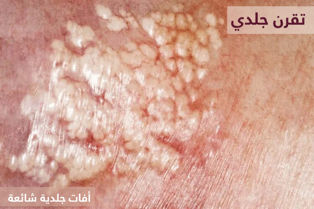 لماذا قد تلاحظ نتوءات بيضاء غير معتادة على شفتيك أو أعضائك الخاصة وما الذي يعنيه ذلك